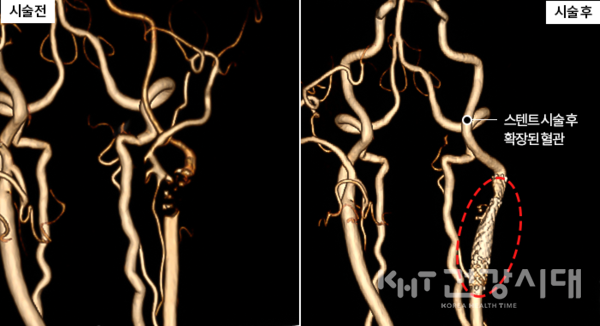 스텐트 시술 후 넓어진 경동맥 협착증 환자의 혈관 사진.(사진=온종합병원 제공)