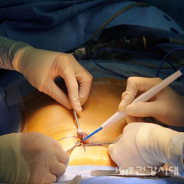 온종합병원 하이테크서저리팀이 단일공 복강경 절제술을 시행하고 있다.(사진=온종합병원 제공)